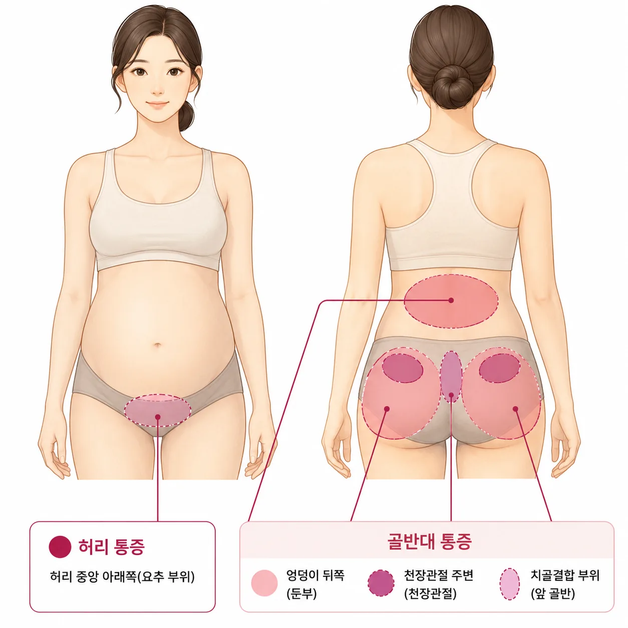 임신 중 허리 통증과 골반통 위치 비교