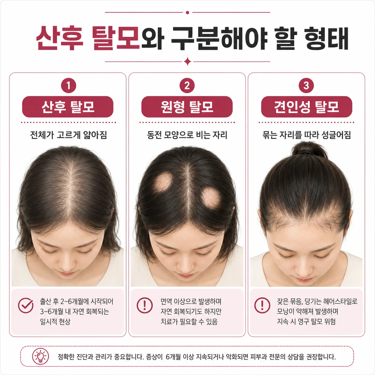 산후 탈모의 전반적 탈락과 원형 탈모·견인성 탈모의 형태 비교 그림
