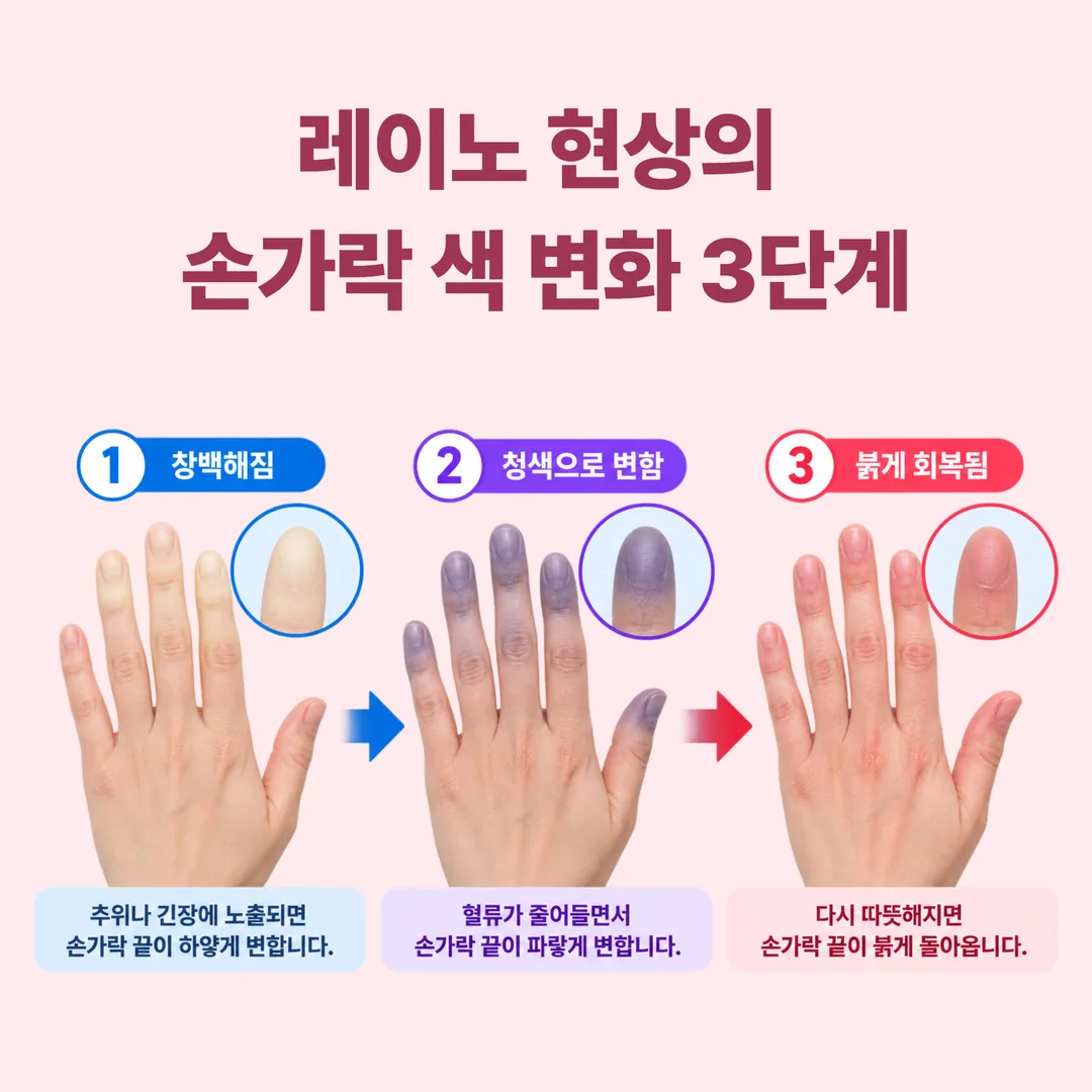 레이노 현상의 손가락 색 변화 3단계