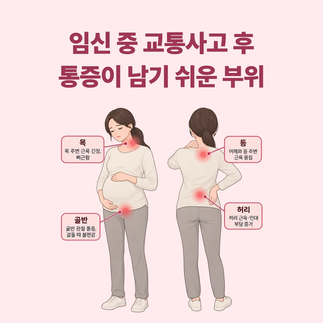 임신 중 교통사고 후 통증이 남기 쉬운 네 부위를 표시한 모식도