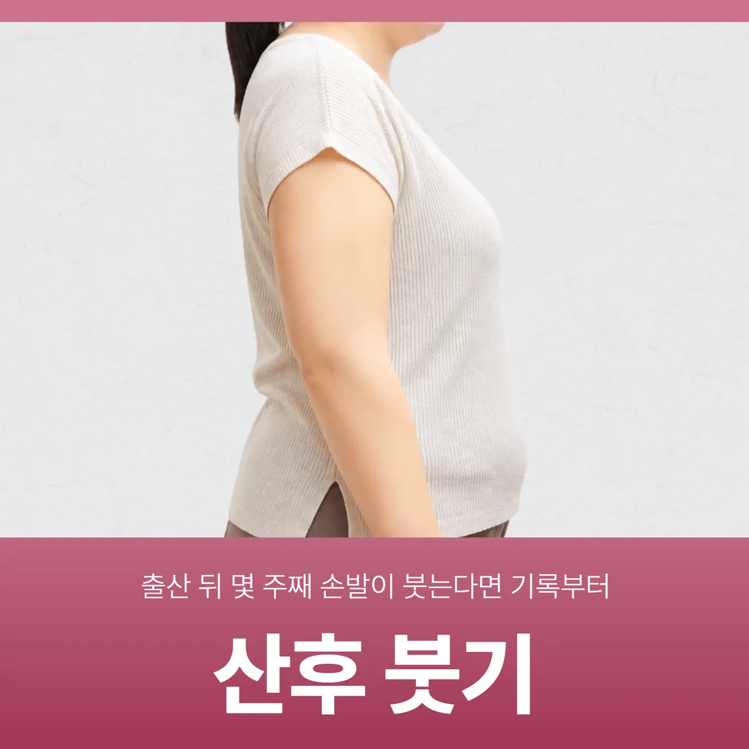 산후 붓기, 출산 뒤 몇 주째 손발이 붓는다면 기록부터